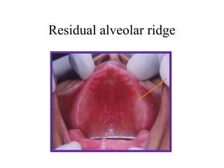Introduction in prosthodontics (dental prosthetics) المحاضرة 5 +6 | PPT