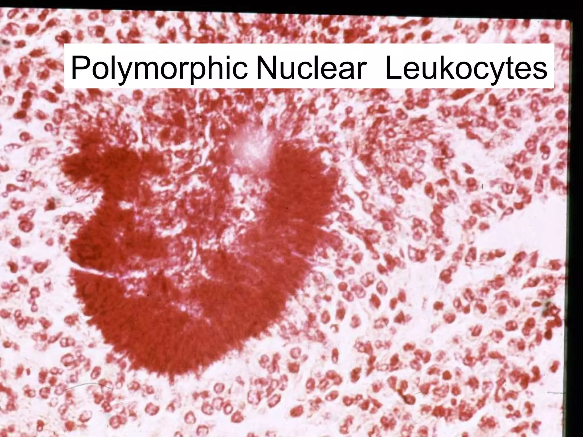 Polymorphic Nuclear Leukocytes
 
