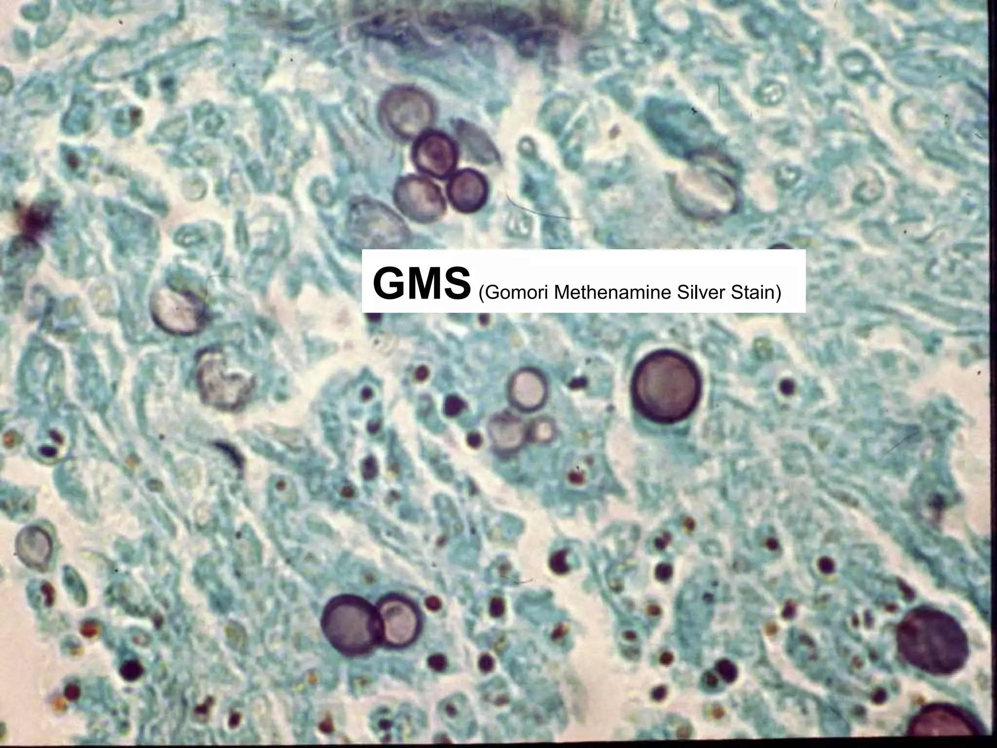 GMS(Gomori Methenamine Silver Stain)
 