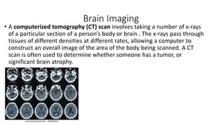 Brain Imaging
• A computerized tomography (CT) scan involves taking a number of x-rays
of a particular section of a person’s body or brain . The x-rays pass through
tissues of different densities at different rates, allowing a computer to
construct an overall image of the area of the body being scanned. A CT
scan is often used to determine whether someone has a tumor, or
significant brain atrophy.
 