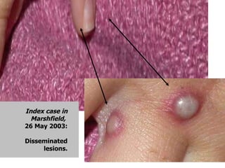 Index case in Marshfield,  26 May 2003: Disseminated lesions. 