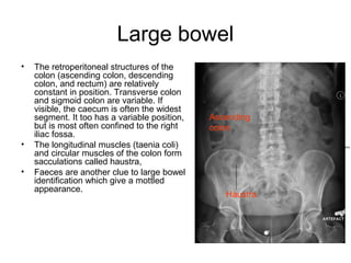 Large bowel
• The retroperitoneal structures of the
colon (ascending colon, descending
colon, and rectum) are relatively
constant in position. Transverse colon
and sigmoid colon are variable. If
visible, the caecum is often the widest
segment. It too has a variable position,
but is most often confined to the right
iliac fossa.
• The longitudinal muscles (taenia coli)
and circular muscles of the colon form
sacculations called haustra,
• Faeces are another clue to large bowel
identification which give a mottled
appearance.
Ascending
colon
Haustra
 