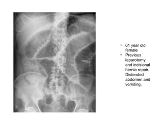 • 61 year old
female
• Previous
laparotomy
and incisional
hernia repair.
Distended
abdomen and
vomiting.
 
