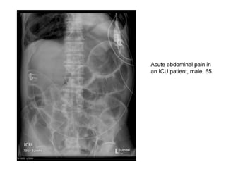 Acute abdominal pain in
an ICU patient, male, 65.
 