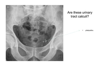 Are these urinary
tract calculi?
• phleboliths
 