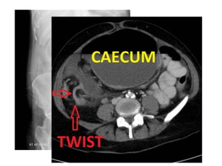 73 year old female
with abdominal pain
and distension
 