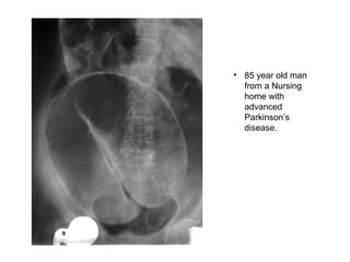 • 85 year old man
from a Nursing
home with
advanced
Parkinson’s
disease.
 