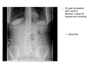 • 35 year old patient
with Crohn’s
disease, 3 days of
nausea and vomiting
• Erect film
 