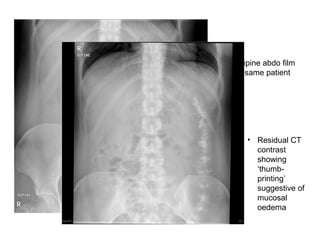 • Supine abdo film
of same patient
• Residual CT
contrast
showing
‘thumb-
printing’
suggestive of
mucosal
oedema
 