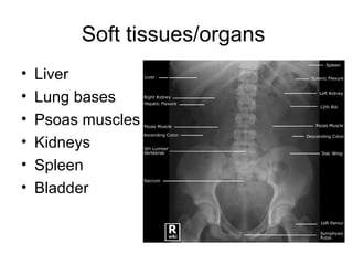 Soft tissues/organs
• Liver
• Lung bases
• Psoas muscles
• Kidneys
• Spleen
• Bladder
 