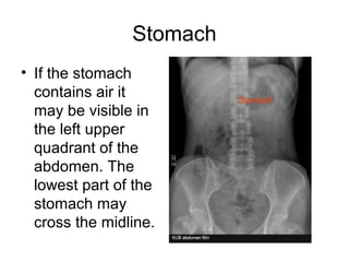 Stomach
• If the stomach
contains air it
may be visible in
the left upper
quadrant of the
abdomen. The
lowest part of the
stomach may
cross the midline.
Stomach
 