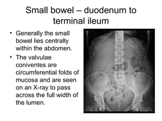 Small bowel – duodenum to
terminal ileum
• Generally the small
bowel lies centrally
within the abdomen.
• The valvulae
coniventes are
circumferential folds of
mucosa and are seen
on an X-ray to pass
across the full width of
the lumen.
 