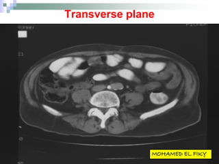 Transverse plane
 
