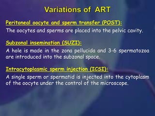 Peritoneal oocyte and sperm transfer (POST):
The oocytes and sperms are placed into the pelvic cavity.
Subzonal insemination (SUZI):
A hole is made in the zona pellucida and 3-6 spermatozoa
are introduced into the subzonal space.
Intracytoplasmic sperm injection (ICSI):
A single sperm or spermatid is injected into the cytoplasm
of the oocyte under the control of the microscope.
 