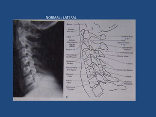 Normal Lateral Atlas Introduction to basics of radiology | PPTX