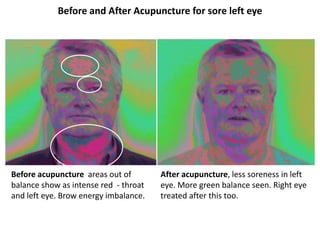 Before and After Acupuncture for sore left eye

Before acupuncture areas out of
balance show as intense red - throat
and left eye. Brow energy imbalance.

After acupuncture, less soreness in left
eye. More green balance seen. Right eye
treated after this too.

 
