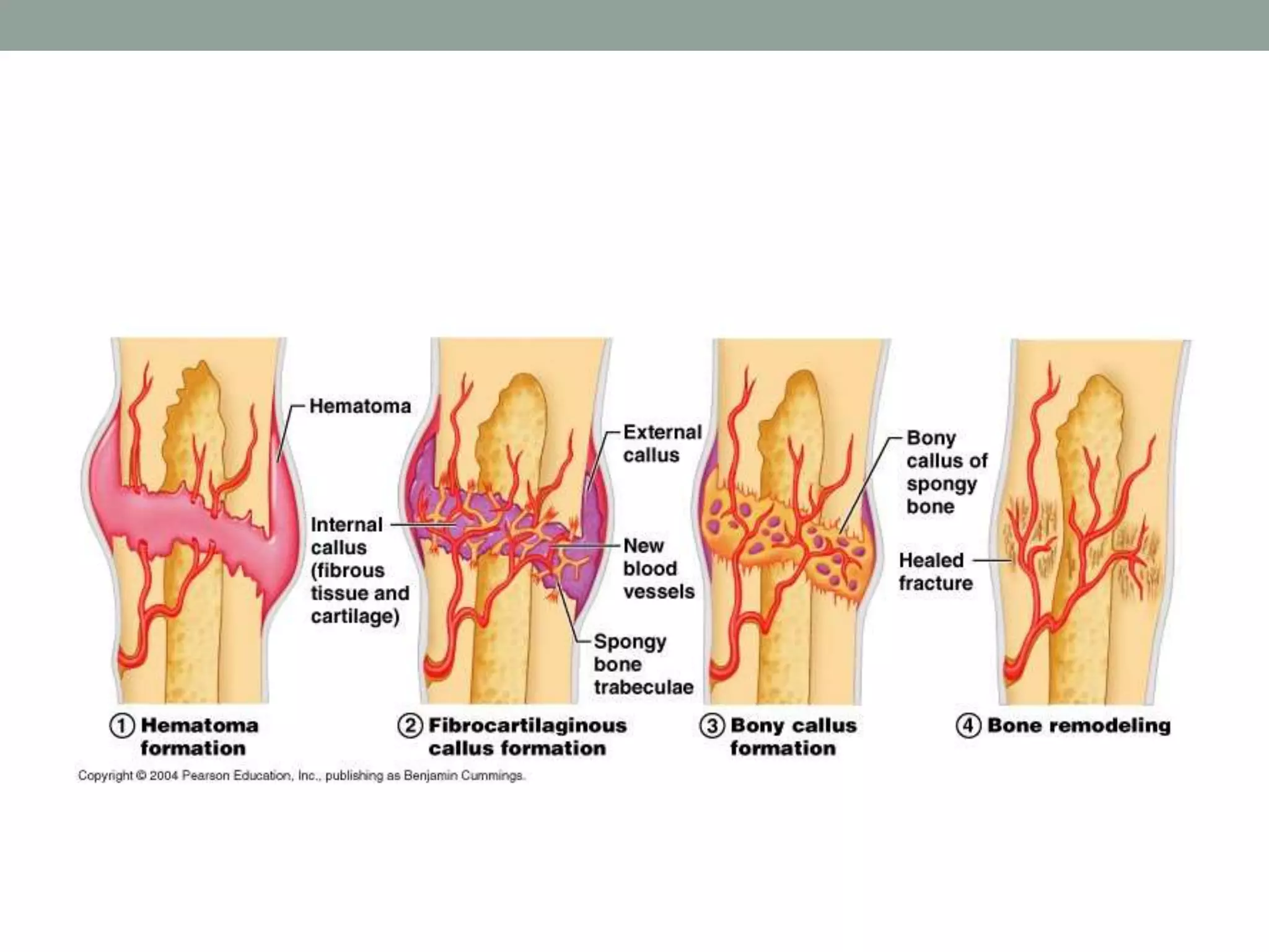 Introduction to bone fracture | PPTX