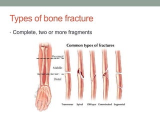 Types of bone fracture 
• Complete, two or more fragments 
 