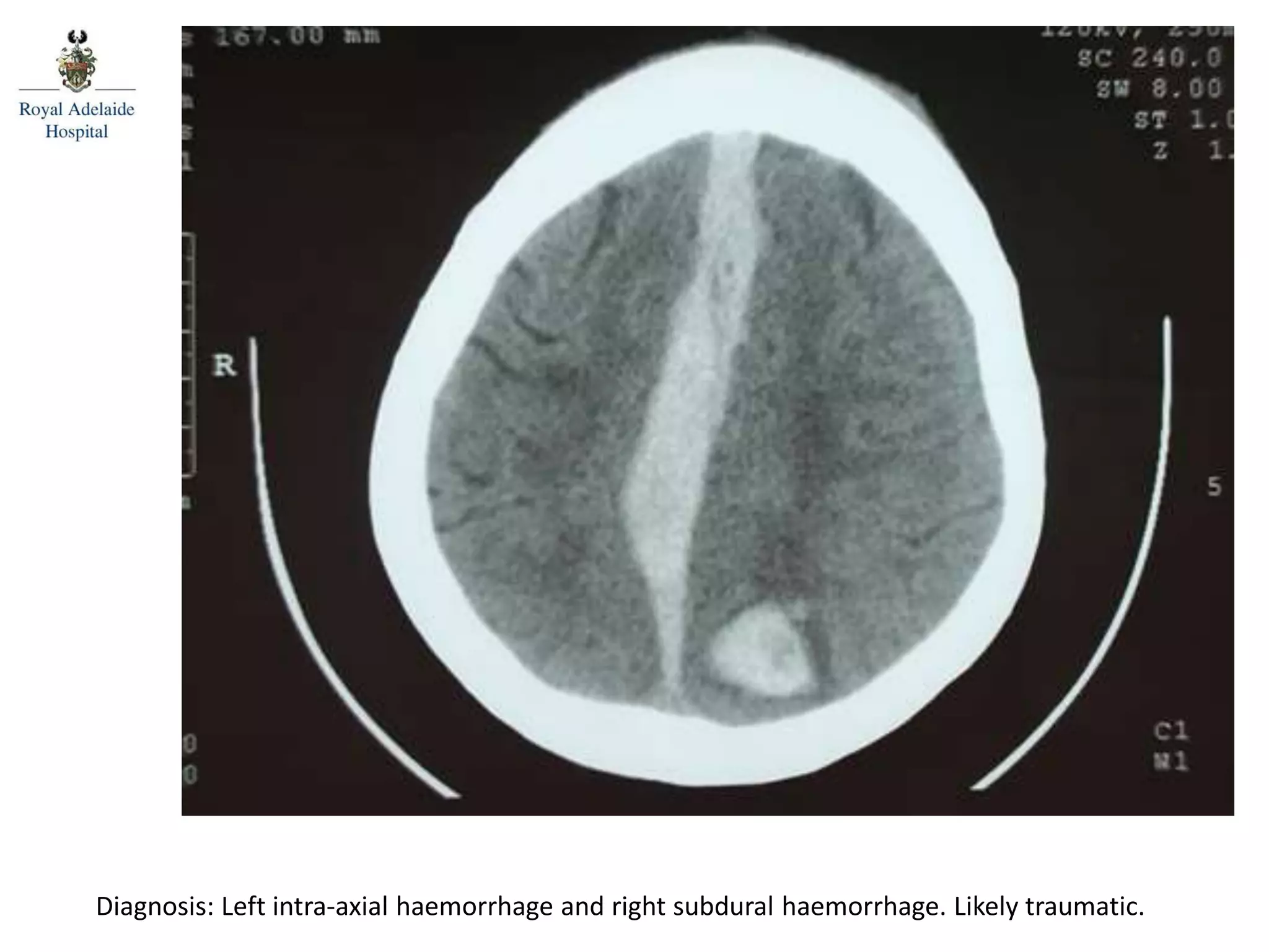 Diagnosis: Left intra-axial haemorrhage and right subdural haemorrhage. Likely traumatic.