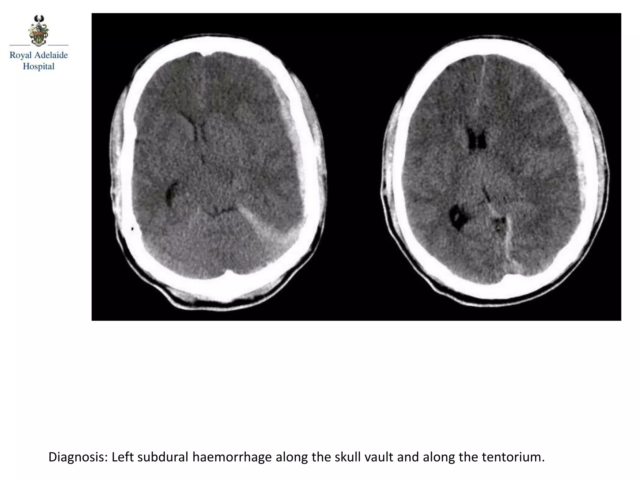 Diagnosis: Left subdural haemorrhage along the skull vault and along the tentorium.