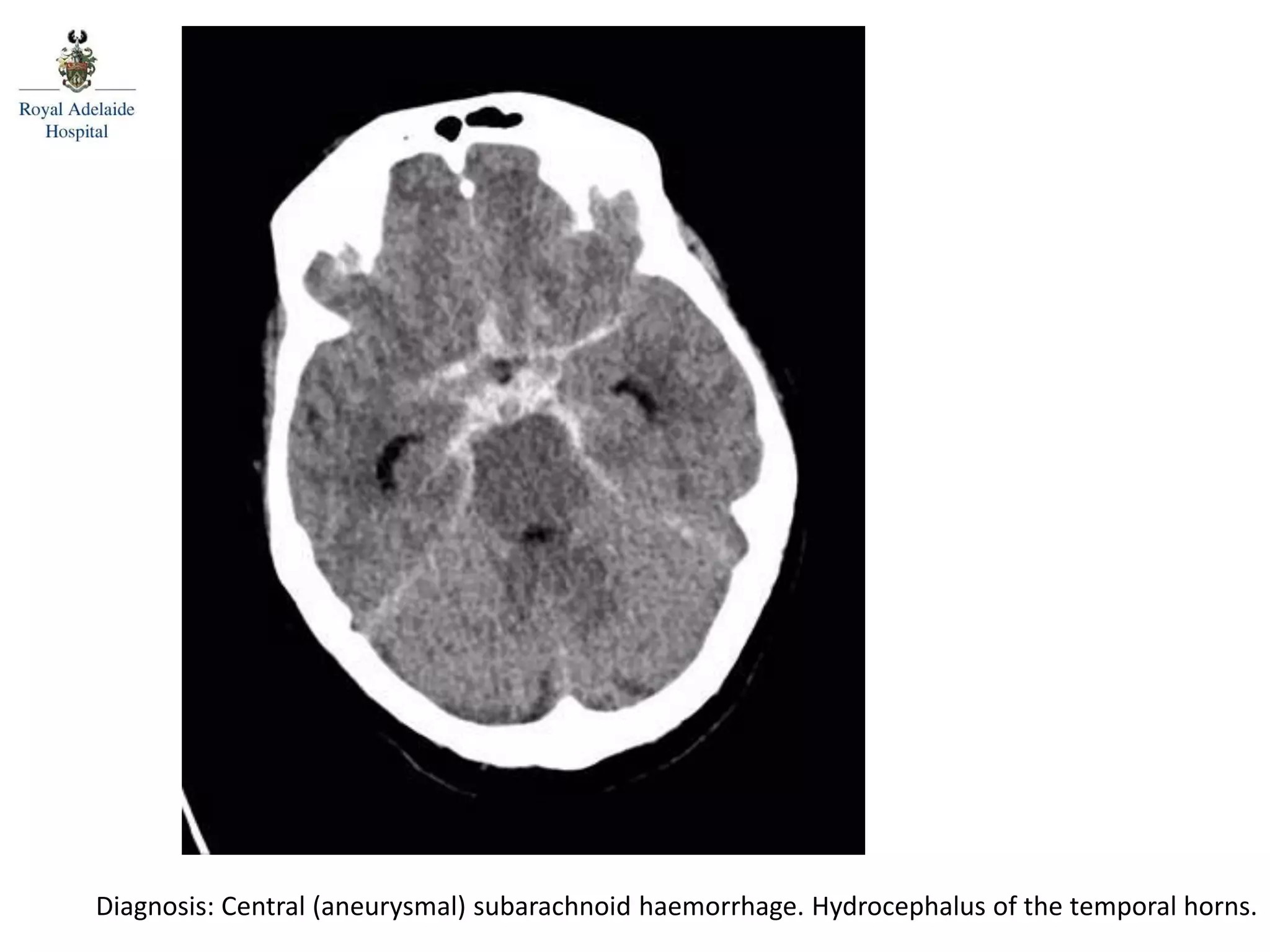 Diagnosis: Central (aneurysmal) subarachnoid haemorrhage. Hydrocephalus of the temporal horns.
