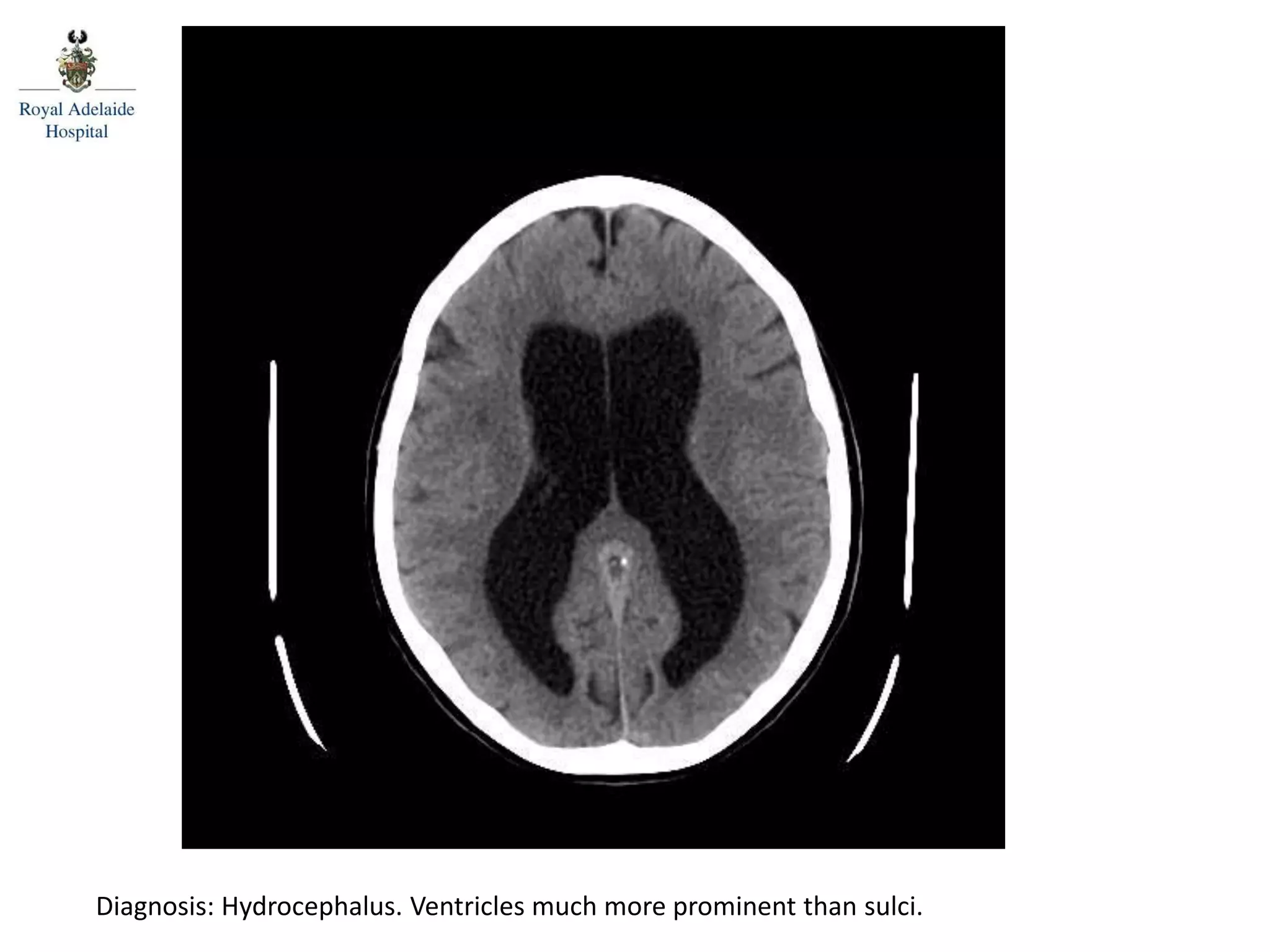 Diagnosis: Hydrocephalus. Ventricles much more prominent than sulci.