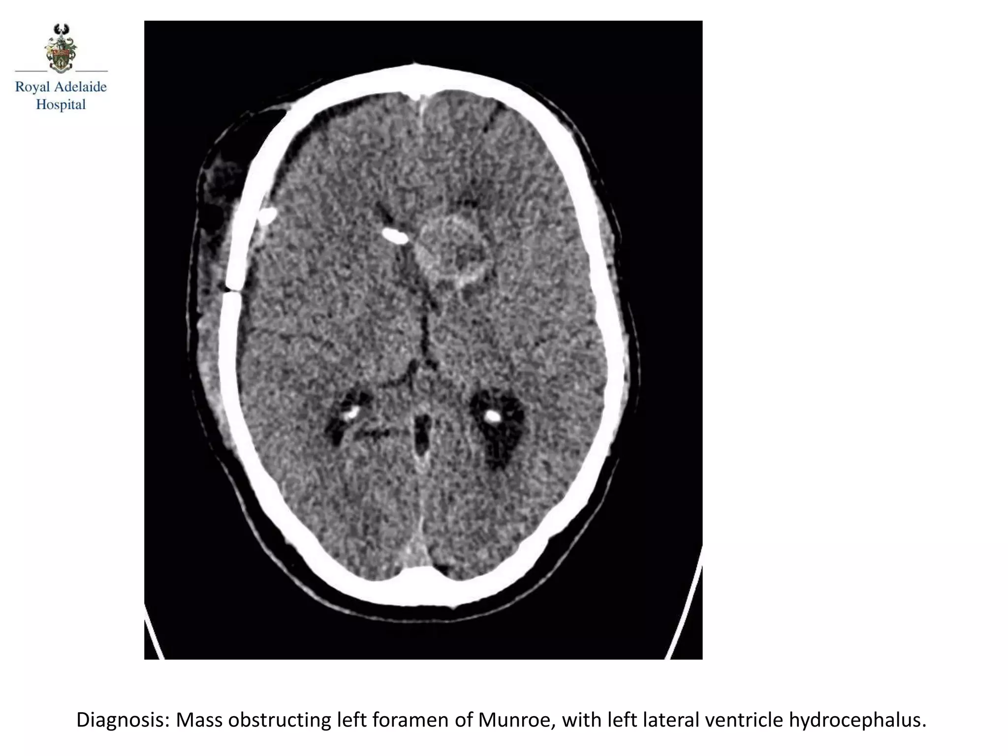 Diagnosis: Mass obstructing left foramen of Munroe, with left lateral ventricle hydrocephalus.
