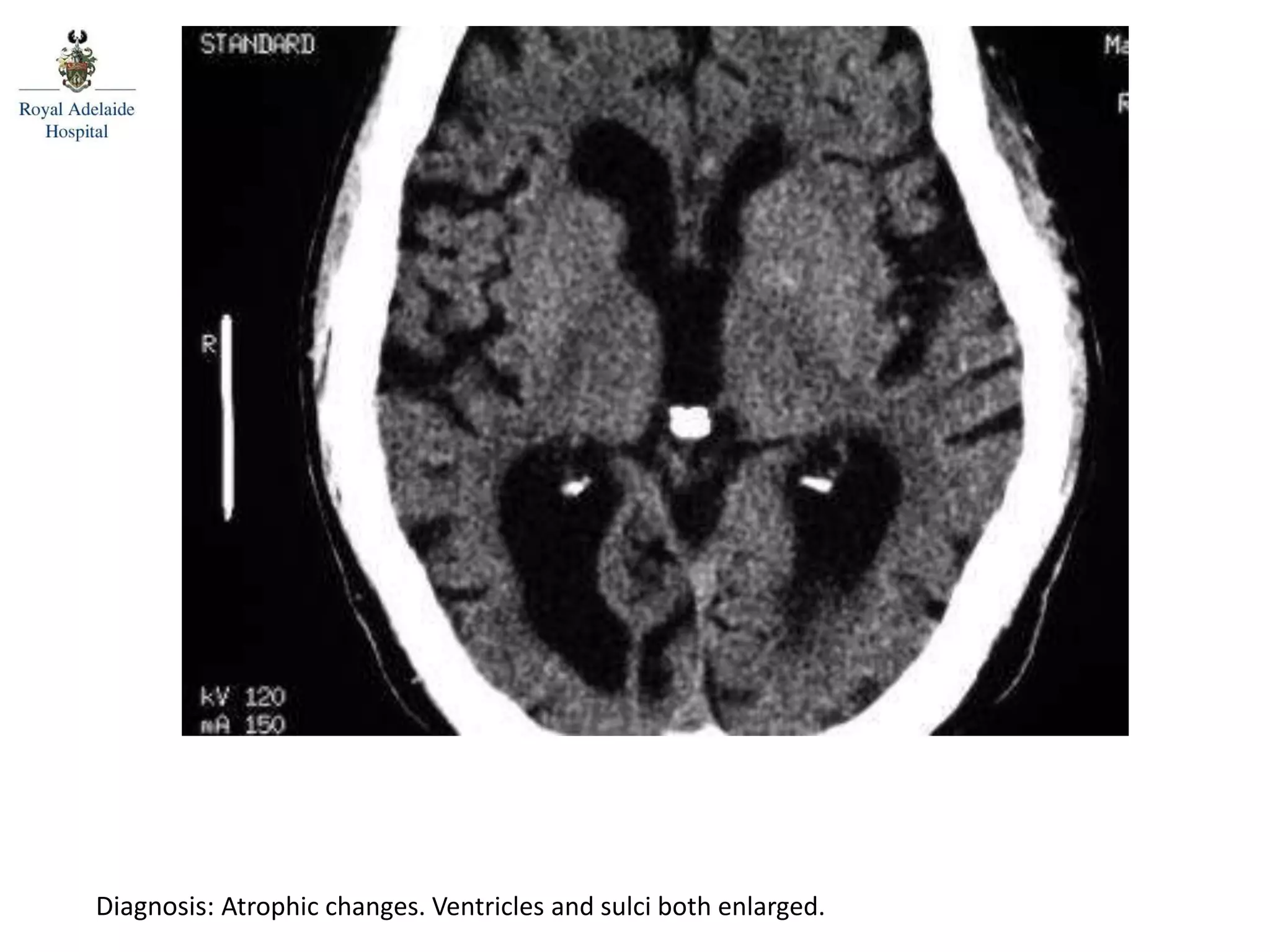Diagnosis: Atrophic changes. Ventricles and sulci both enlarged.