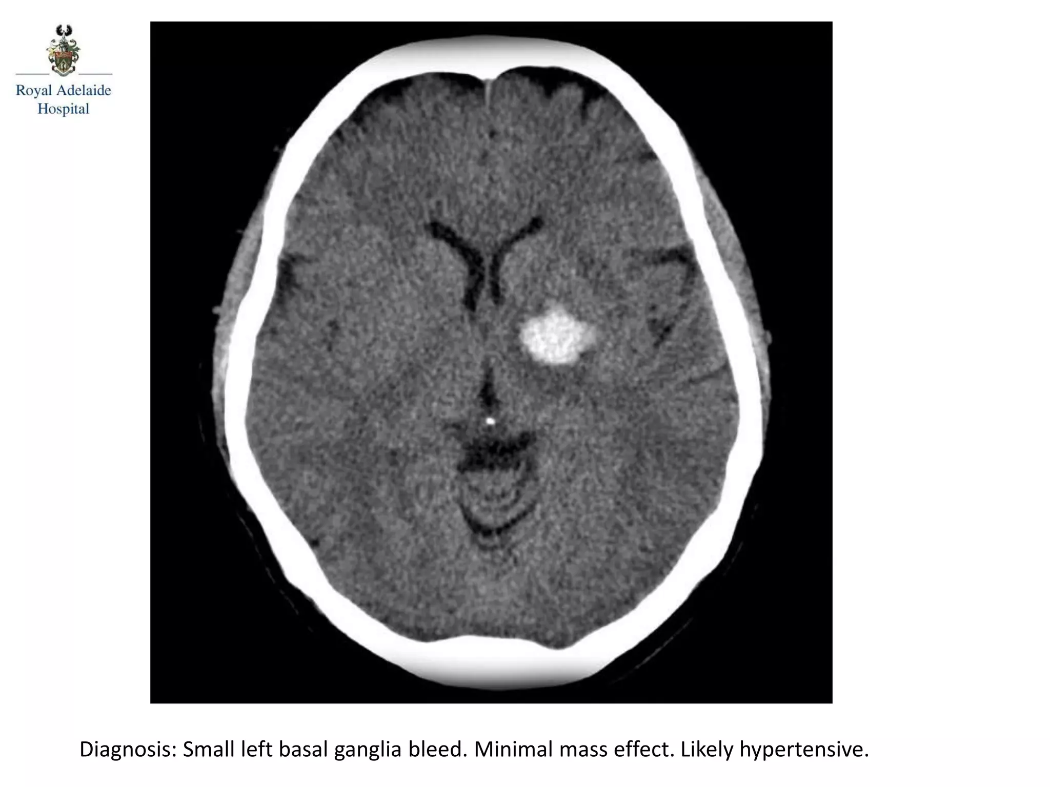 Diagnosis: Small left basal ganglia bleed. Minimal mass effect. Likely hypertensive.
Posterior spinal line