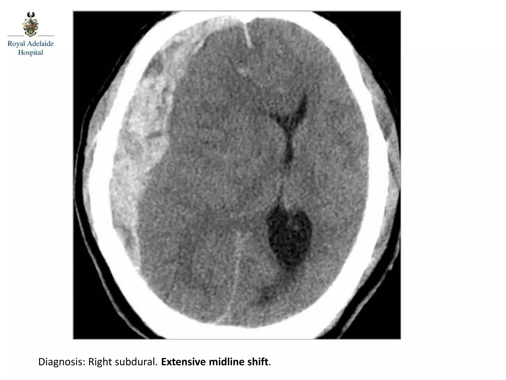 Diagnosis: Right subdural. Extensive midline shift.
Posterior spinal line