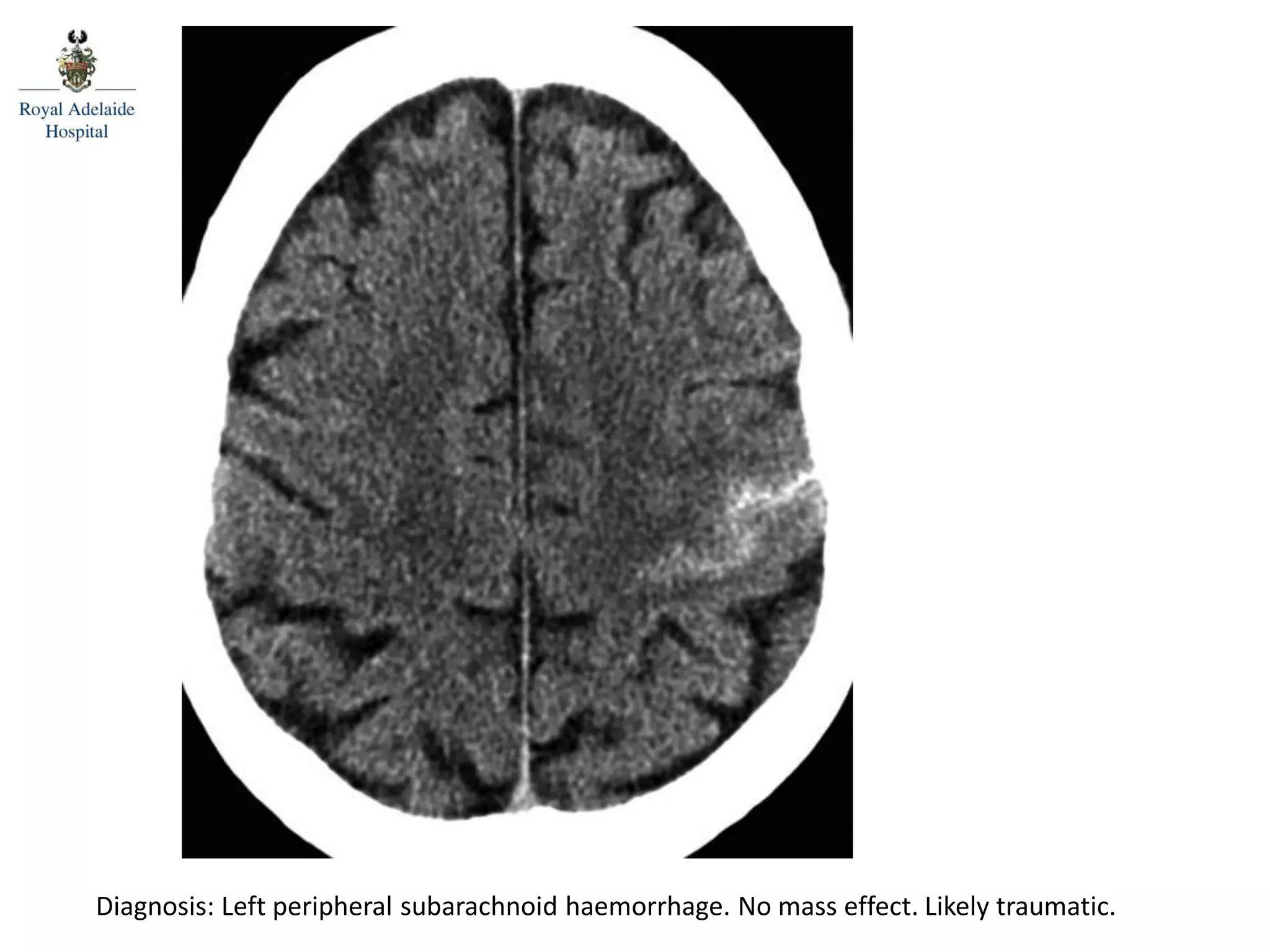 Posterior spinal line
Diagnosis: Left peripheral subarachnoid haemorrhage. No mass effect. Likely traumatic.