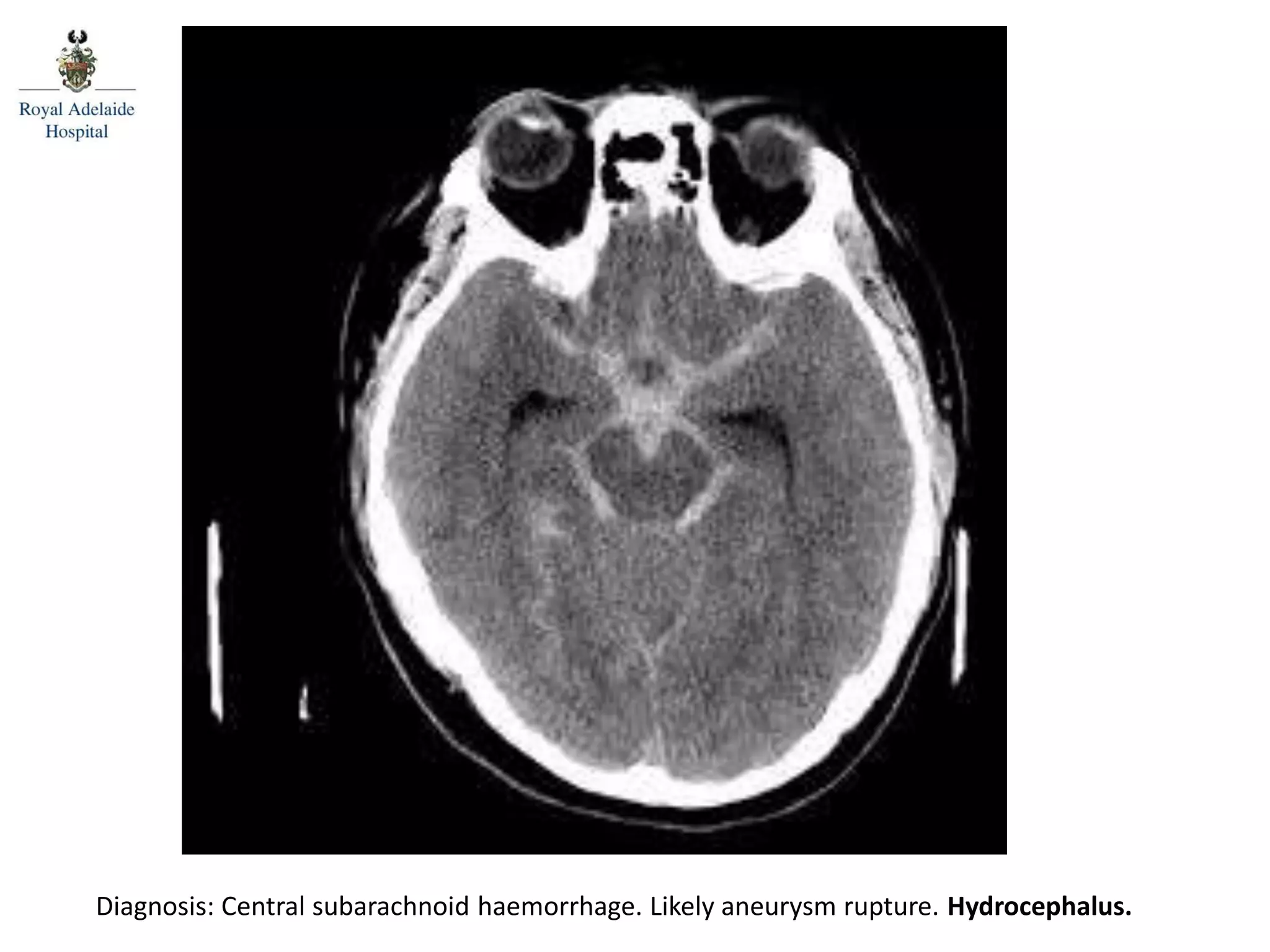 Posterior spinal line
Diagnosis: Central subarachnoid haemorrhage. Likely aneurysm rupture. Hydrocephalus.