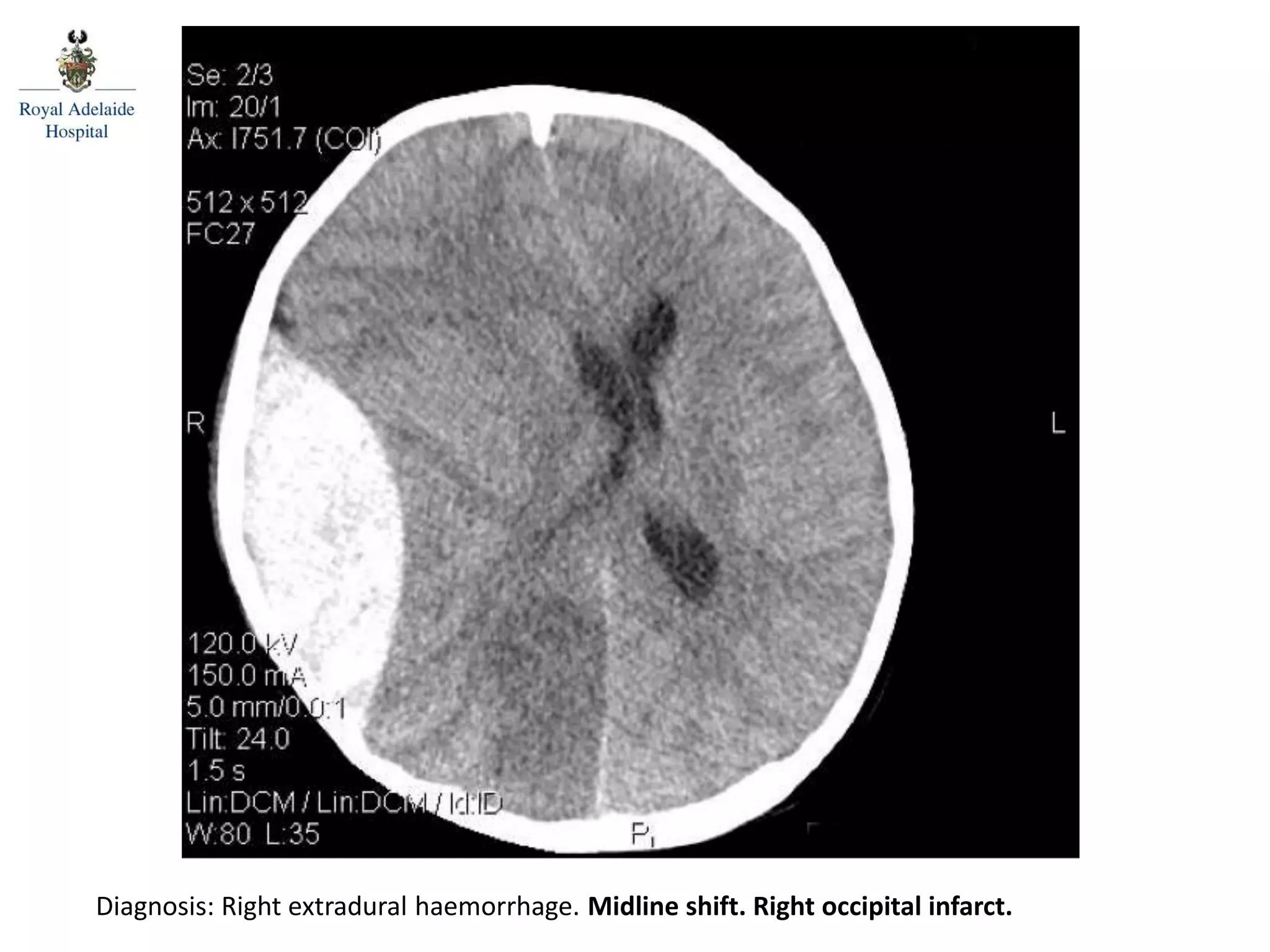 Posterior spinal line
Diagnosis: Right extradural haemorrhage. Midline shift. Right occipital infarct.