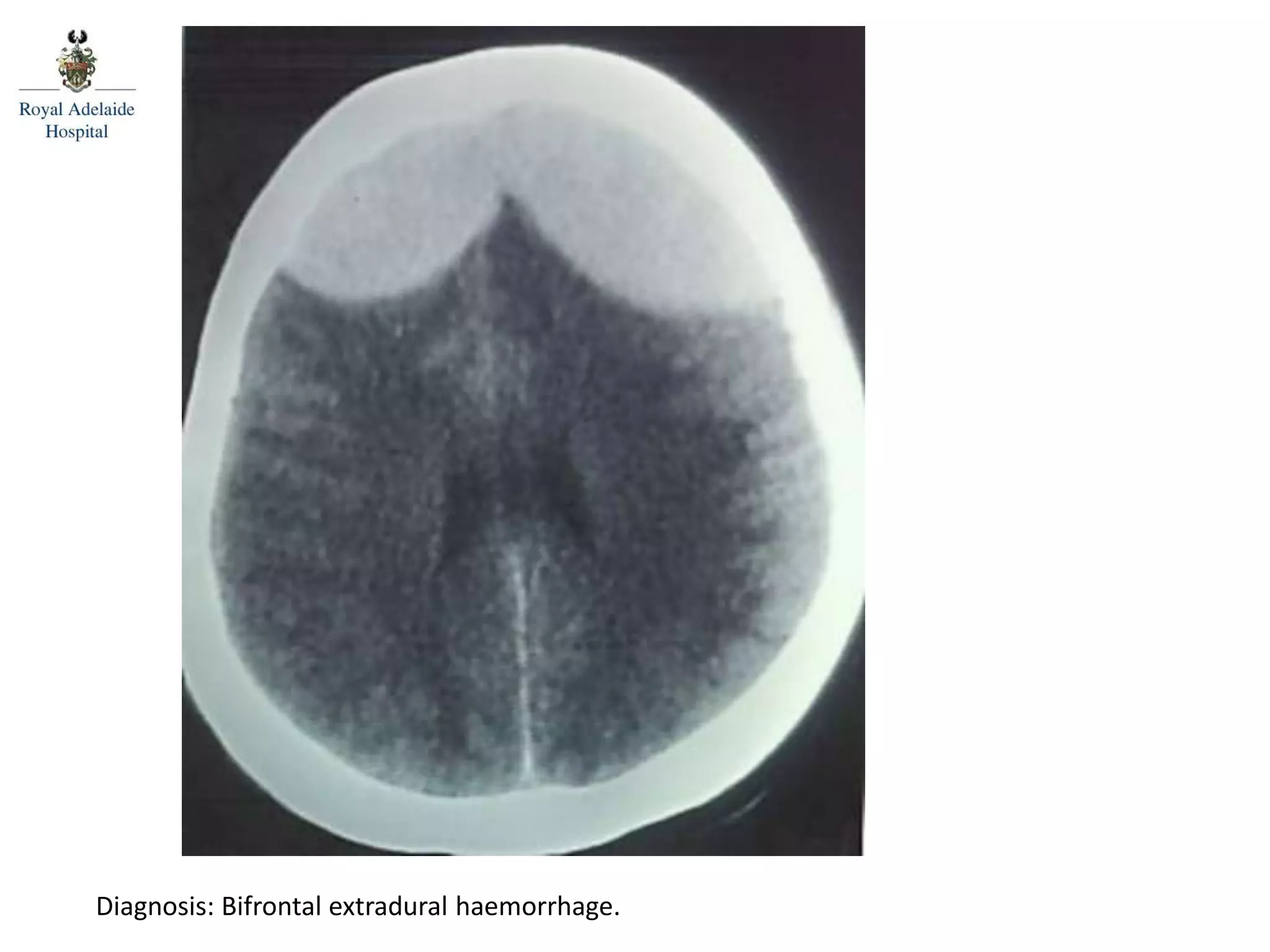 Posterior spinal line
Diagnosis: Bifrontal extradural haemorrhage.