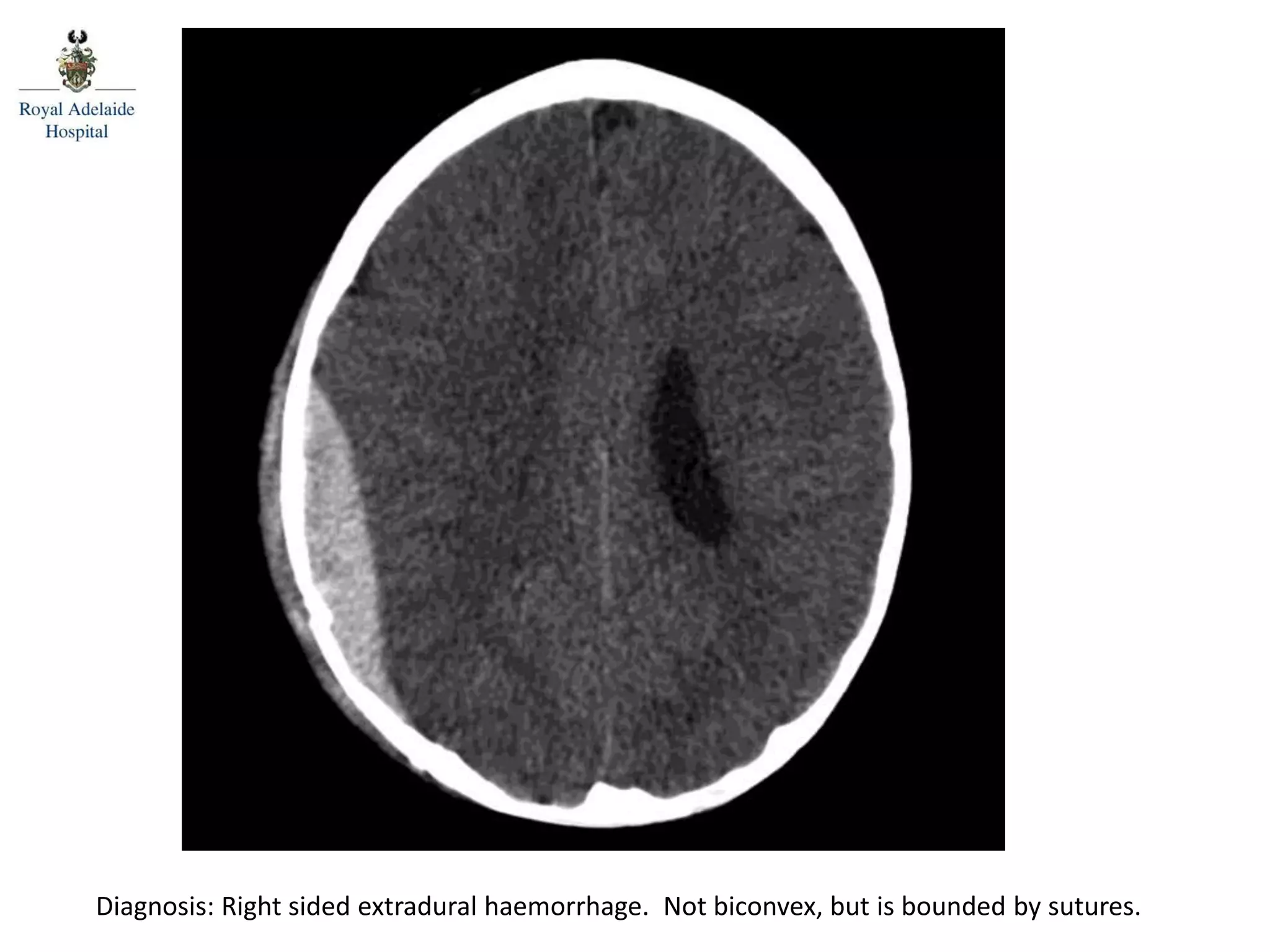Posterior spinal line
Diagnosis: Right sided extradural haemorrhage. Not biconvex, but is bounded by sutures.