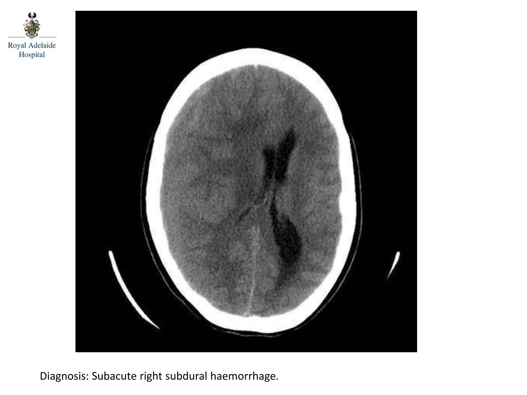 Diagnosis: Subacute right subdural haemorrhage.
