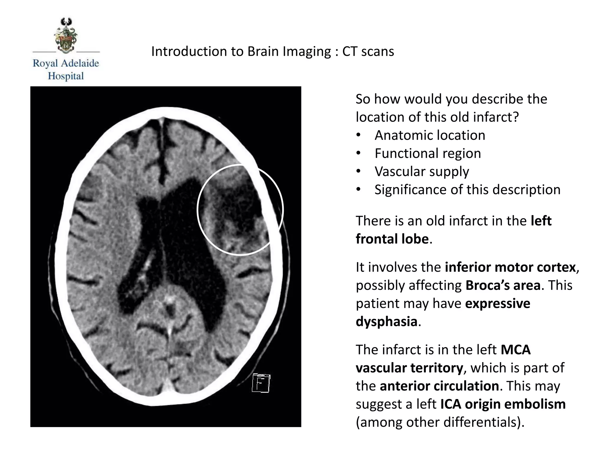 So how would you describe the
location of this old infarct?
• Anatomic location
• Functional region
• Vascular supply
• Significance of this description
There is an old infarct in the left
frontal lobe.
It involves the inferior motor cortex,
possibly affecting Broca’s area. This
patient may have expressive
dysphasia.
The infarct is in the left MCA
vascular territory, which is part of
the anterior circulation. This may
suggest a left ICA origin embolism
(among other differentials).
Introduction to Brain Imaging : CT scans
 