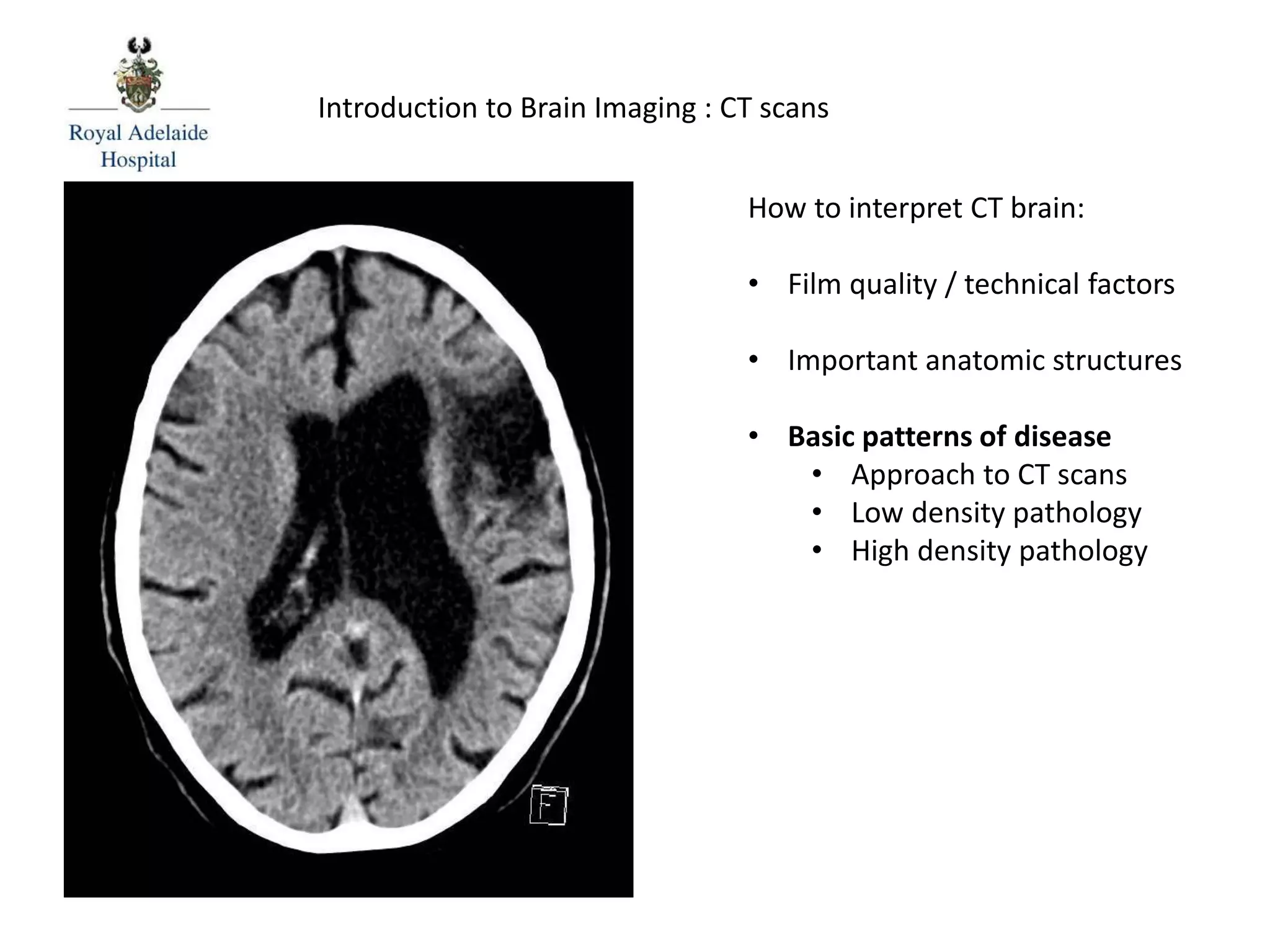 How to interpret CT brain:
• Film quality / technical factors
• Important anatomic structures
• Basic patterns of disease
• Approach to CT scans
• Low density pathology
• High density pathology
Introduction to Brain Imaging : CT scans
 