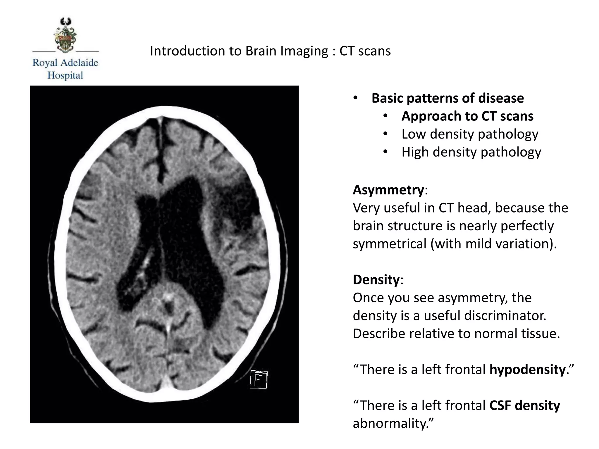• Basic patterns of disease
• Approach to CT scans
• Low density pathology
• High density pathology
Asymmetry:
Very useful in CT head, because the
brain structure is nearly perfectly
symmetrical (with mild variation).
Density:
Once you see asymmetry, the
density is a useful discriminator.
Describe relative to normal tissue.
“There is a left frontal hypodensity.”
“There is a left frontal CSF density
abnormality.”
Introduction to Brain Imaging : CT scans
 