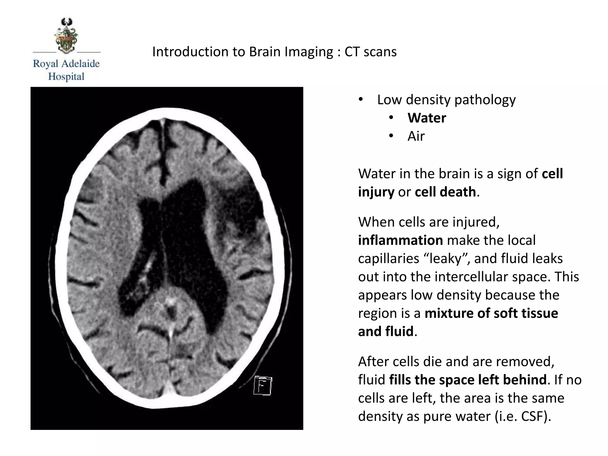 • Low density pathology
• Water
• Air
Water in the brain is a sign of cell
injury or cell death.
When cells are injured,
inflammation make the local
capillaries “leaky”, and fluid leaks
out into the intercellular space. This
appears low density because the
region is a mixture of soft tissue
and fluid.
After cells die and are removed,
fluid fills the space left behind. If no
cells are left, the area is the same
density as pure water (i.e. CSF).
Introduction to Brain Imaging : CT scans
 