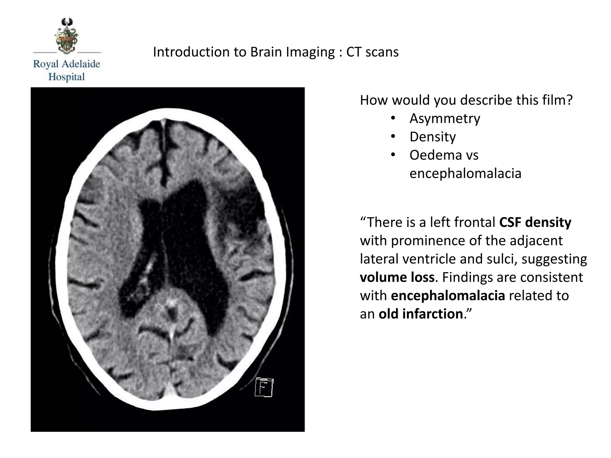 How would you describe this film?
• Asymmetry
• Density
• Oedema vs
encephalomalacia
“There is a left frontal CSF density
with prominence of the adjacent
lateral ventricle and sulci, suggesting
volume loss. Findings are consistent
with encephalomalacia related to
an old infarction.”
Introduction to Brain Imaging : CT scans
 