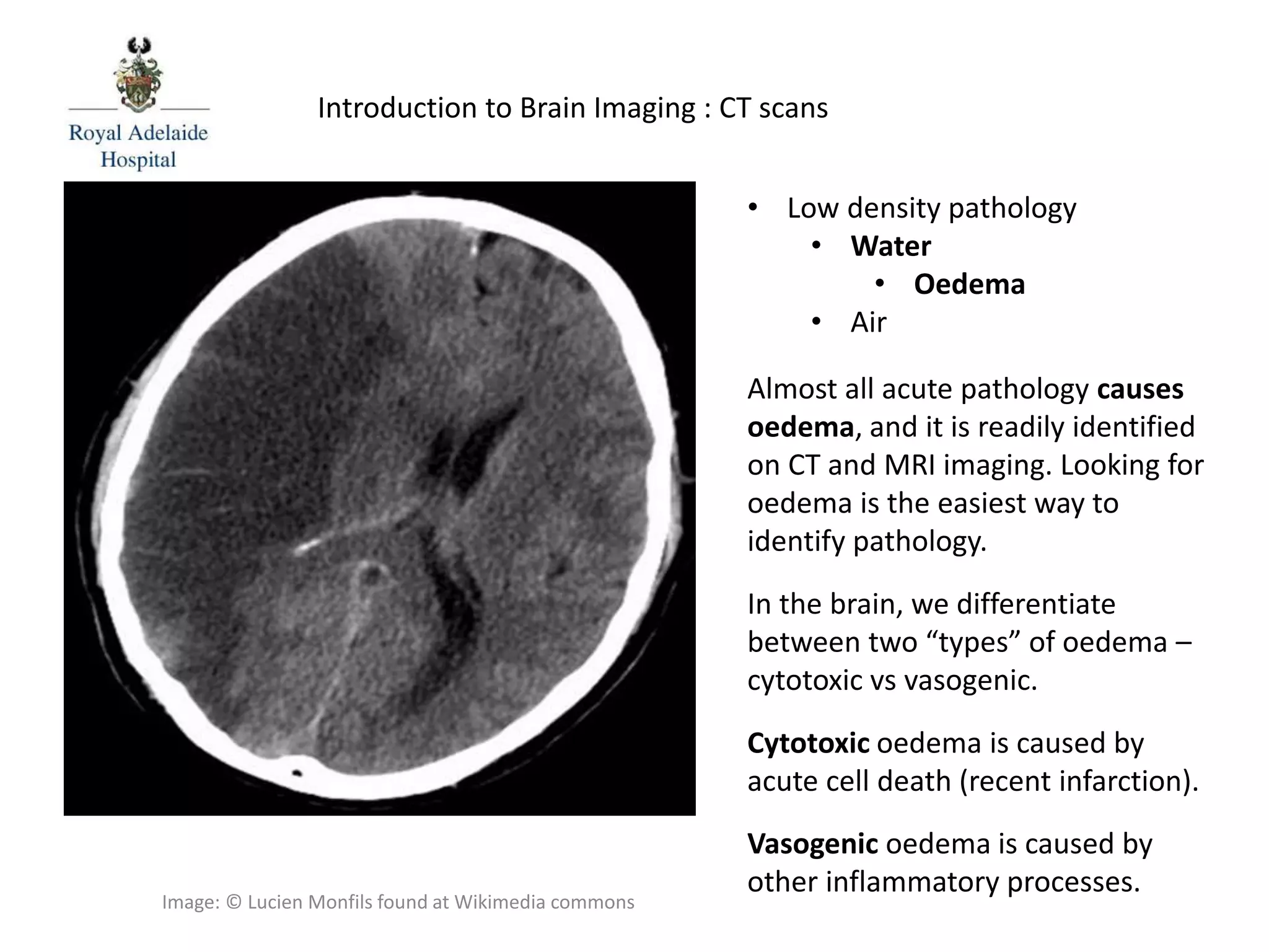 Almost all acute pathology causes
oedema, and it is readily identified
on CT and MRI imaging. Looking for
oedema is the easiest way to
identify pathology.
In the brain, we differentiate
between two “types” of oedema –
cytotoxic vs vasogenic.
Cytotoxic oedema is caused by
acute cell death (recent infarction).
Vasogenic oedema is caused by
other inflammatory processes.
Introduction to Brain Imaging : CT scans
• Low density pathology
• Water
• Oedema
• Air
Image: © Lucien Monfils found at Wikimedia commons
 