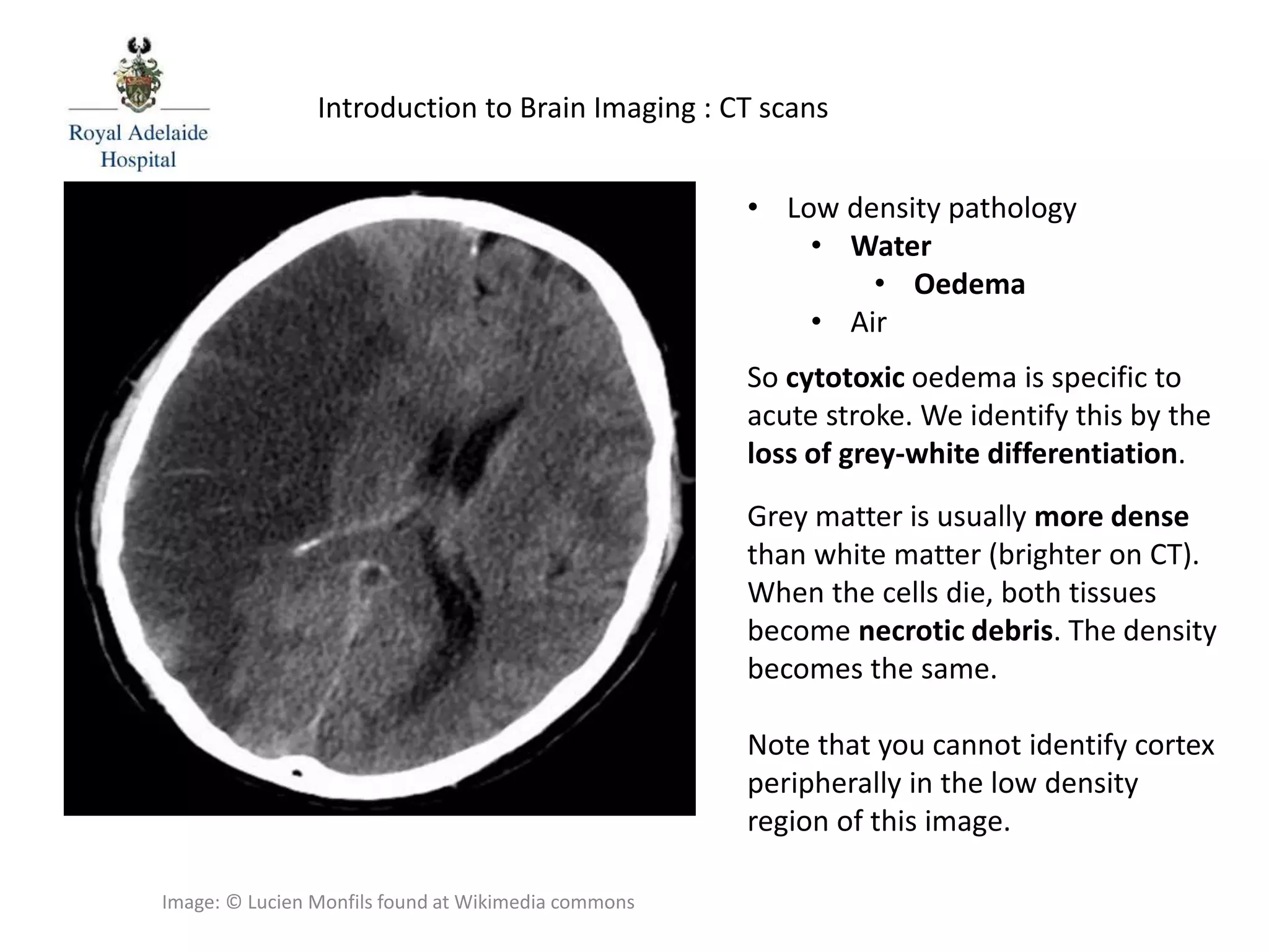 So cytotoxic oedema is specific to
acute stroke. We identify this by the
loss of grey-white differentiation.
Grey matter is usually more dense
than white matter (brighter on CT).
When the cells die, both tissues
become necrotic debris. The density
becomes the same.
Note that you cannot identify cortex
peripherally in the low density
region of this image.
Introduction to Brain Imaging : CT scans
• Low density pathology
• Water
• Oedema
• Air
Image: © Lucien Monfils found at Wikimedia commons
 