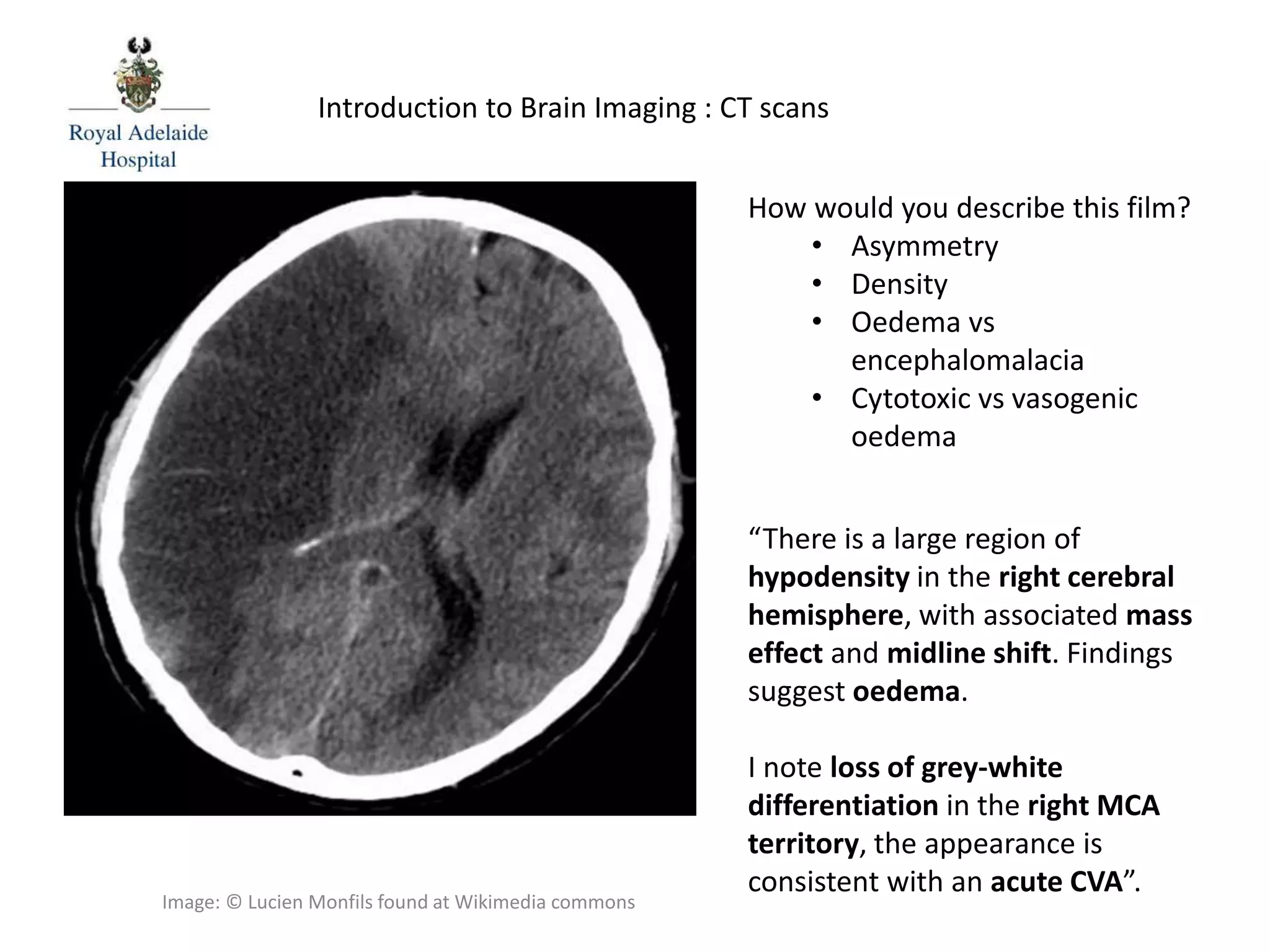 “There is a large region of
hypodensity in the right cerebral
hemisphere, with associated mass
effect and midline shift. Findings
suggest oedema.
I note loss of grey-white
differentiation in the right MCA
territory, the appearance is
consistent with an acute CVA”.
Introduction to Brain Imaging : CT scans
How would you describe this film?
• Asymmetry
• Density
• Oedema vs
encephalomalacia
• Cytotoxic vs vasogenic
oedema
Image: © Lucien Monfils found at Wikimedia commons
 