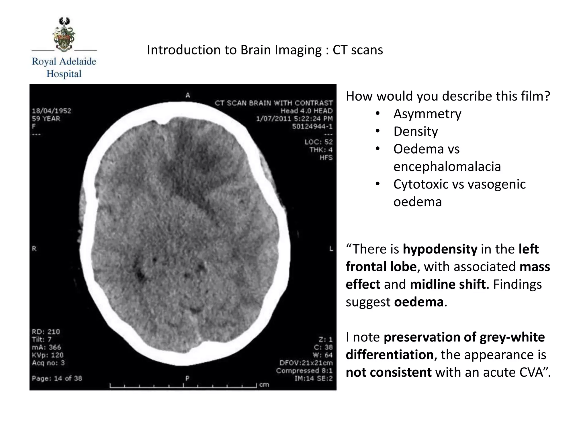 “There is hypodensity in the left
frontal lobe, with associated mass
effect and midline shift. Findings
suggest oedema.
I note preservation of grey-white
differentiation, the appearance is
not consistent with an acute CVA”.
Introduction to Brain Imaging : CT scans
How would you describe this film?
• Asymmetry
• Density
• Oedema vs
encephalomalacia
• Cytotoxic vs vasogenic
oedema
 