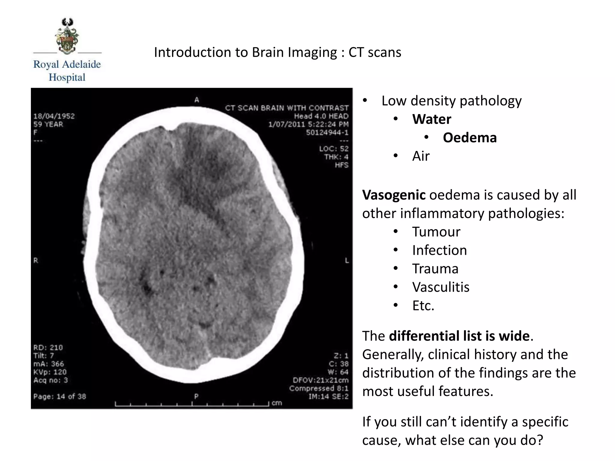 Introduction to Brain Imaging : CT scans
Vasogenic oedema is caused by all
other inflammatory pathologies:
• Tumour
• Infection
• Trauma
• Vasculitis
• Etc.
The differential list is wide.
Generally, clinical history and the
distribution of the findings are the
most useful features.
If you still can’t identify a specific
cause, what else can you do?
• Low density pathology
• Water
• Oedema
• Air
 