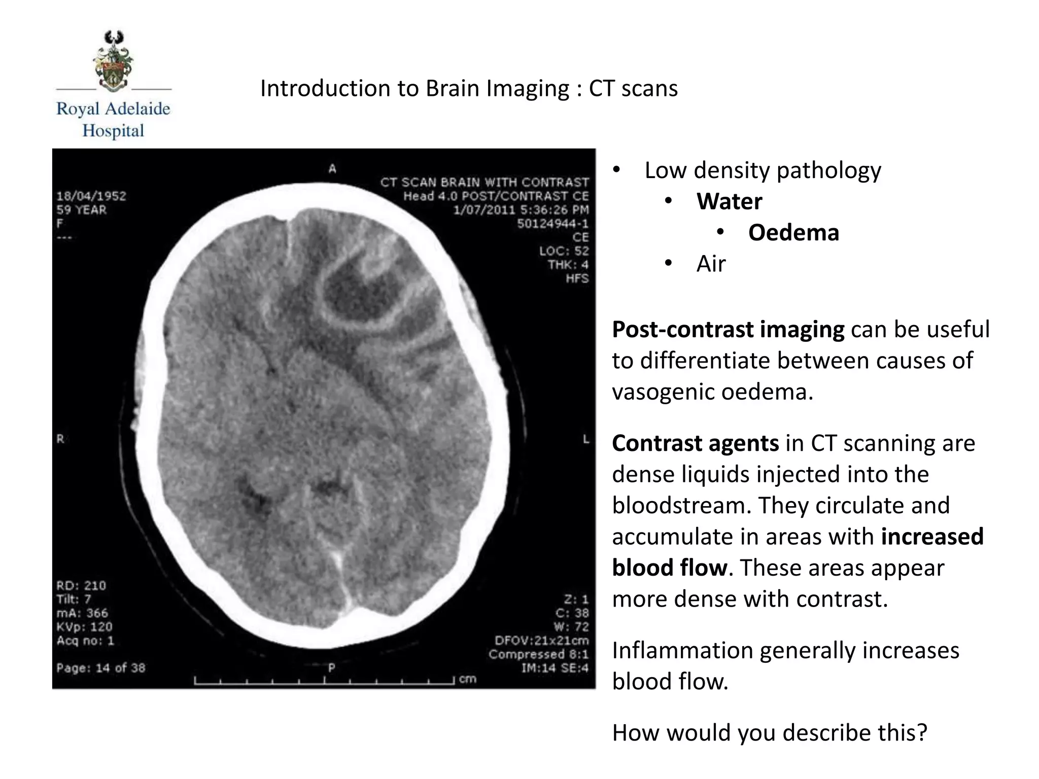 Introduction to Brain Imaging : CT scans
Post-contrast imaging can be useful
to differentiate between causes of
vasogenic oedema.
Contrast agents in CT scanning are
dense liquids injected into the
bloodstream. They circulate and
accumulate in areas with increased
blood flow. These areas appear
more dense with contrast.
Inflammation generally increases
blood flow.
How would you describe this?
• Low density pathology
• Water
• Oedema
• Air
 