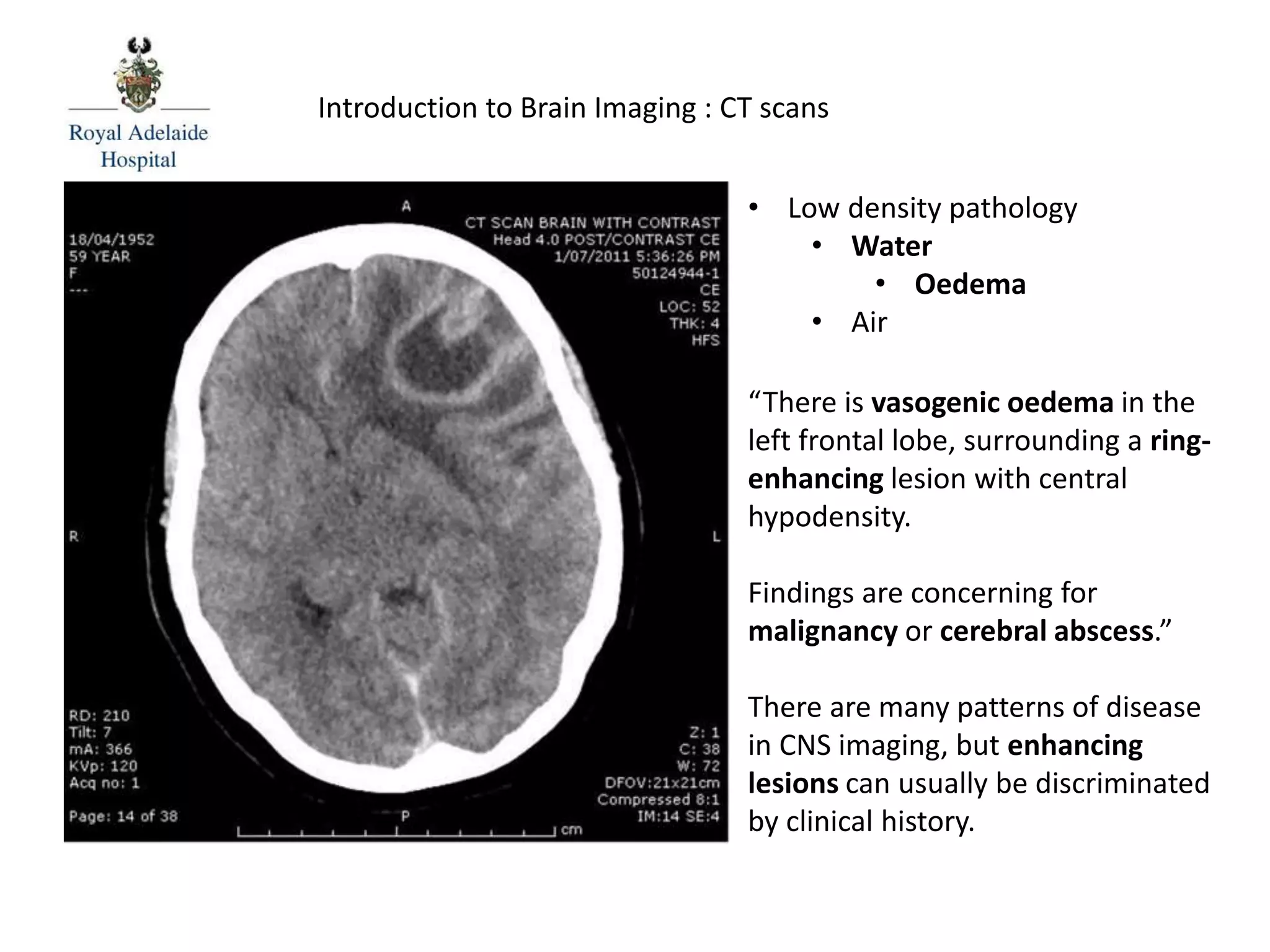 Introduction to Brain Imaging : CT scans
“There is vasogenic oedema in the
left frontal lobe, surrounding a ring-
enhancing lesion with central
hypodensity.
Findings are concerning for
malignancy or cerebral abscess.”
There are many patterns of disease
in CNS imaging, but enhancing
lesions can usually be discriminated
by clinical history.
• Low density pathology
• Water
• Oedema
• Air
 