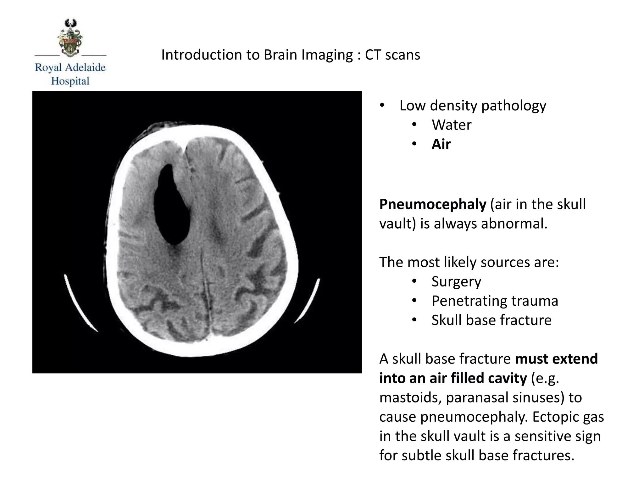 Introduction to Brain Imaging : CT scans
Pneumocephaly (air in the skull
vault) is always abnormal.
The most likely sources are:
• Surgery
• Penetrating trauma
• Skull base fracture
A skull base fracture must extend
into an air filled cavity (e.g.
mastoids, paranasal sinuses) to
cause pneumocephaly. Ectopic gas
in the skull vault is a sensitive sign
for subtle skull base fractures.
• Low density pathology
• Water
• Air
 