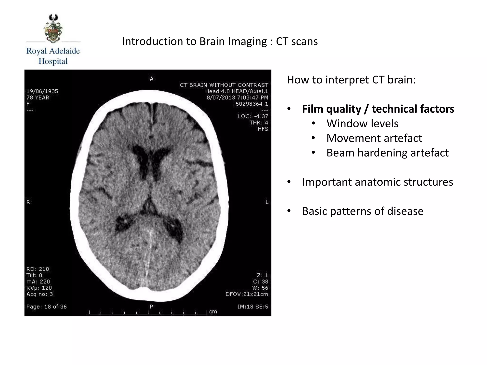 How to interpret CT brain:
• Film quality / technical factors
• Window levels
• Movement artefact
• Beam hardening artefact
• Important anatomic structures
• Basic patterns of disease
Introduction to Brain Imaging : CT scans
 